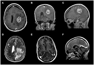Case Report: Frontoparietal Metastasis From a Primary Fallopian Tube Carcinoma